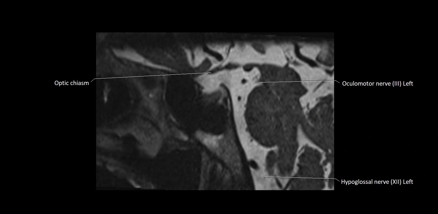 Cranial nerve sagittal anatomy MRI 3T image 29.webp